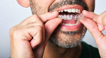 Close-up of person inserting clear dental aligner onto upper teeth